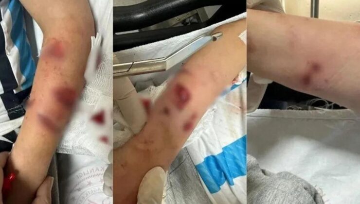 Rize’de sokak köpeklerinin saldırısına uğrayan çocuk yaralandı